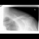 Fracture of the lateral end of the collar bone (clavicle): X-ray - Plain radiograph